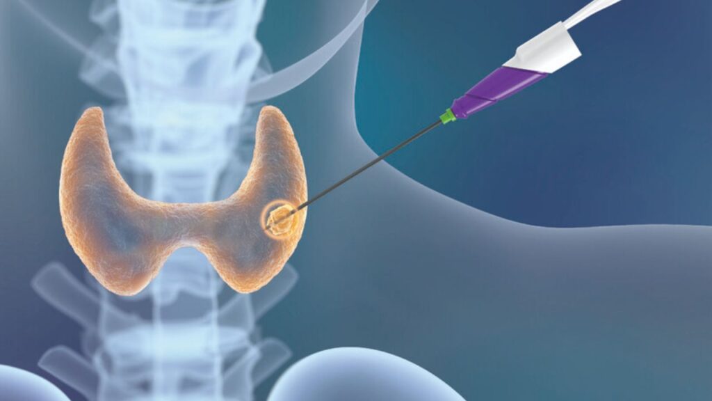 A medical illustration showing a thin electrode probe targeting a specific nodule within the thyroid gland for thermal ablation.
