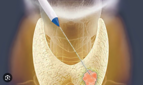 Illustration of a thyroid radiofrequency ablation procedure showing a specialized needle probe treating a thyroid nodule.