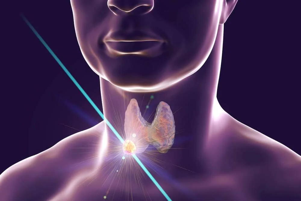 Medical illustration of a thyroid nodule being treated with Radiofrequency Ablation (RFA) laser beam on a human neck.